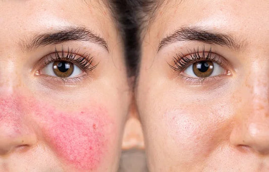 I’m Not Blushing… It’s Rosacea