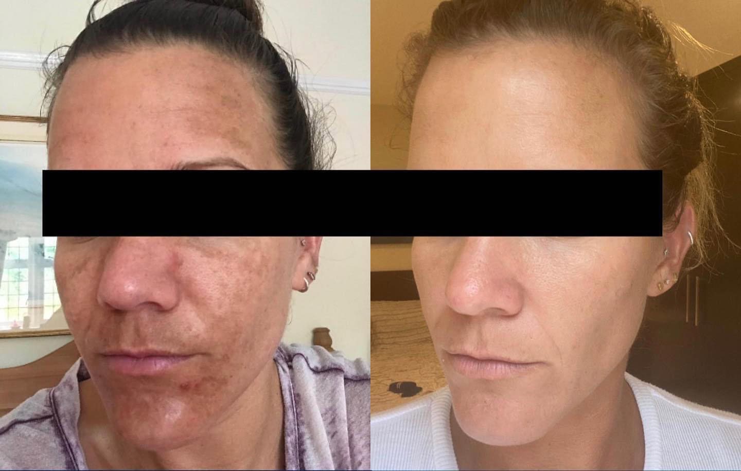 The Best Hyperpigmentation Products SkinAddict.co.uk