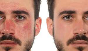 The Do's and Don'ts of Skincare for Rosacea