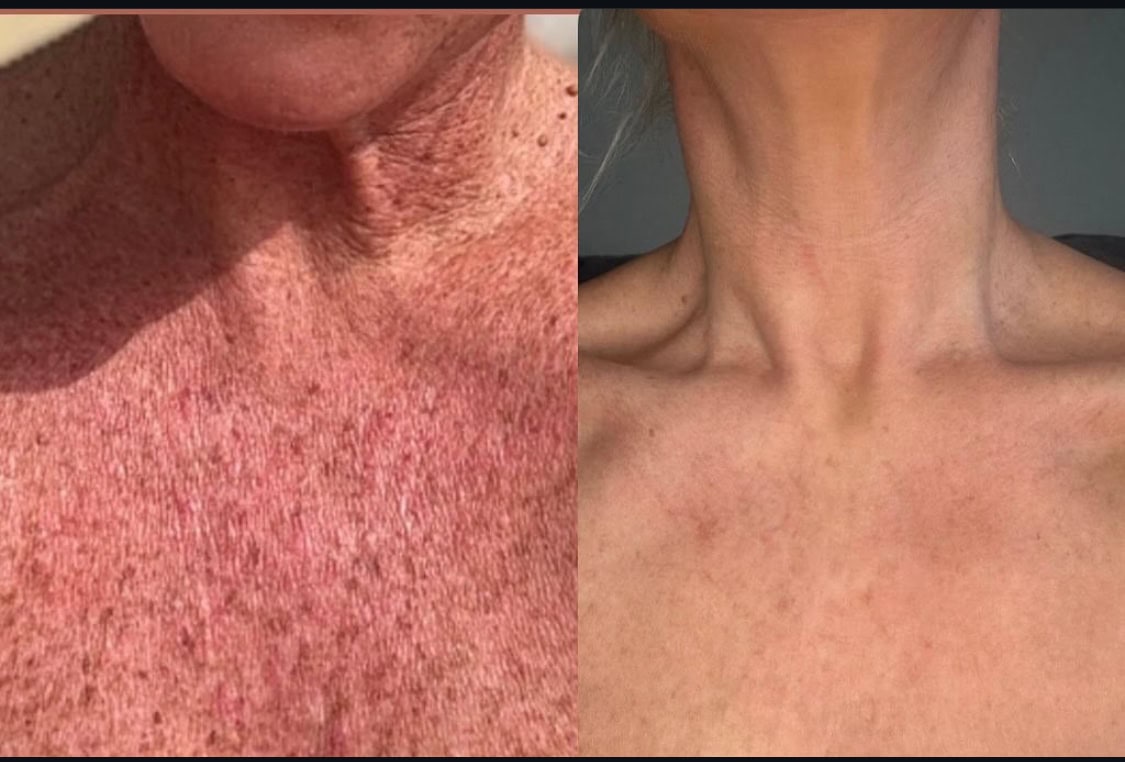 DermaQuest MelaQuest Cysteamine Serum, Before and After