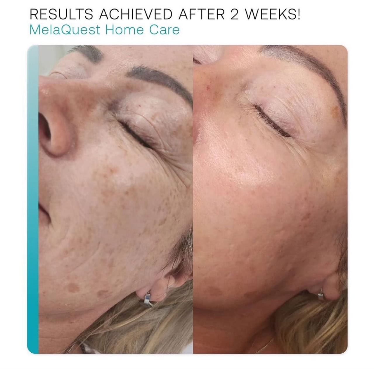 Melaquest results, after two weeks